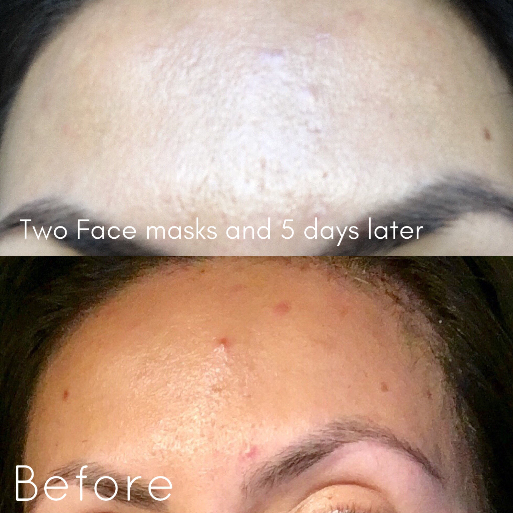 Acne prone skin before and after aztec clay mask